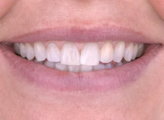 dental veneer before and after