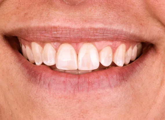 after porcelain veneers - Colorado Springs