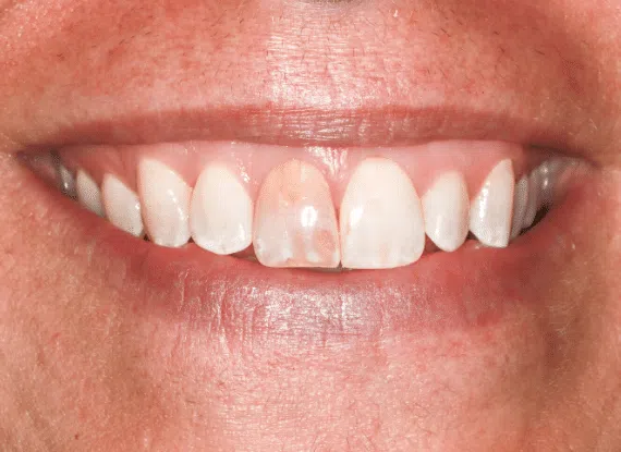 porcelain veneers Colorado Springs