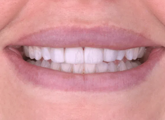 dental veneers Colorado Springs CO