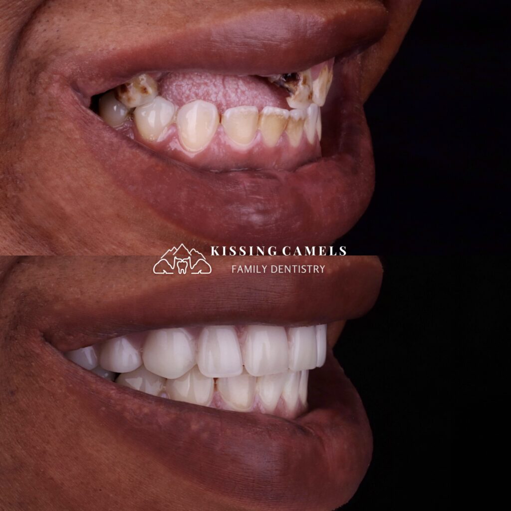 dental implants in colorado springs