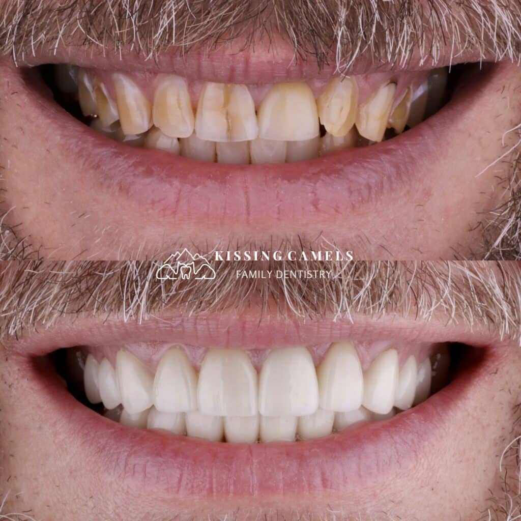 dental implants colorado springs