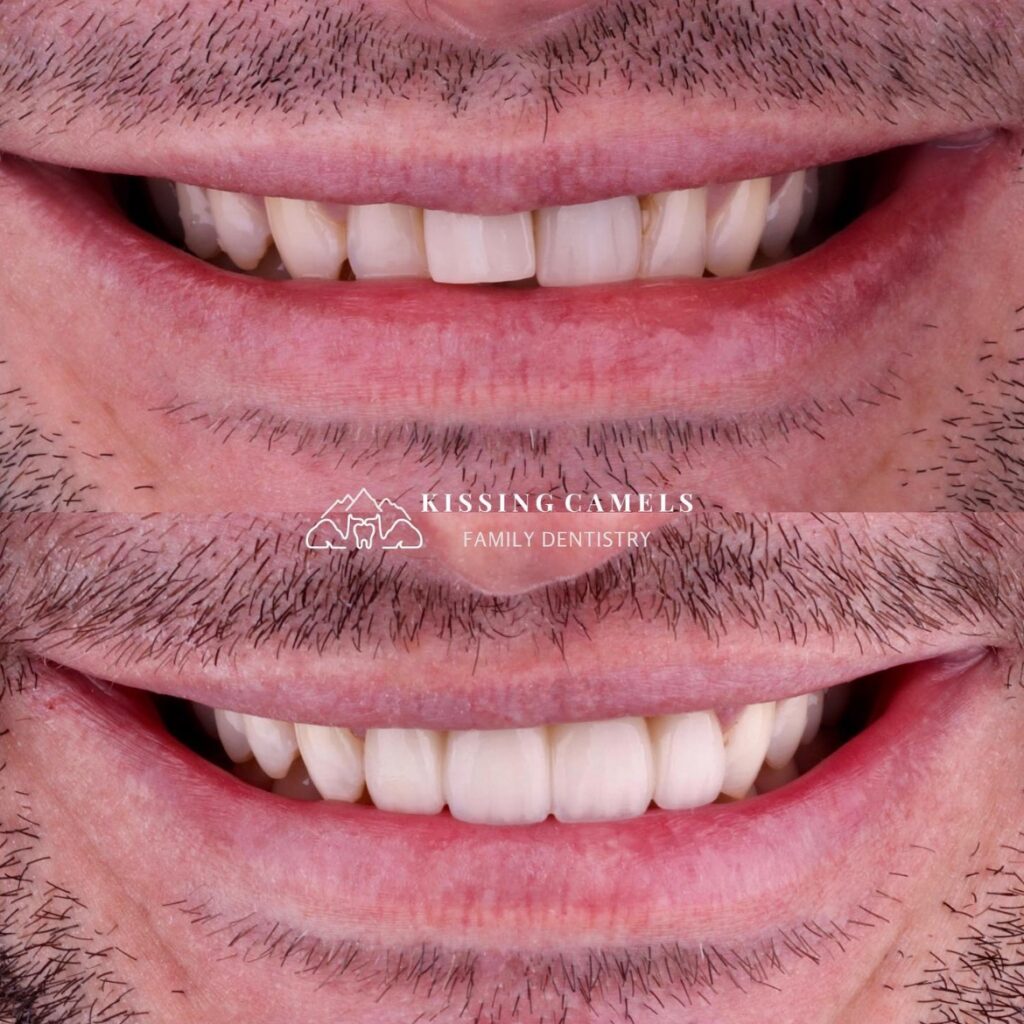 Dentures in colorado springs